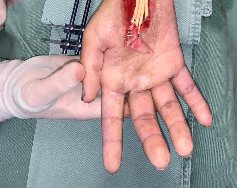 Equipe médica da Santa Casa reconstrói mão e antebraço de paciente