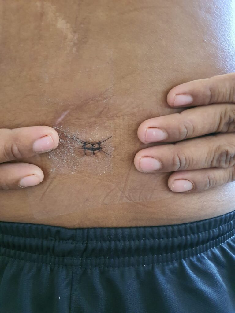 Neurocirurgiões da Santa Casa realizam cirurgia minimamente invasiva em coluna de paciente