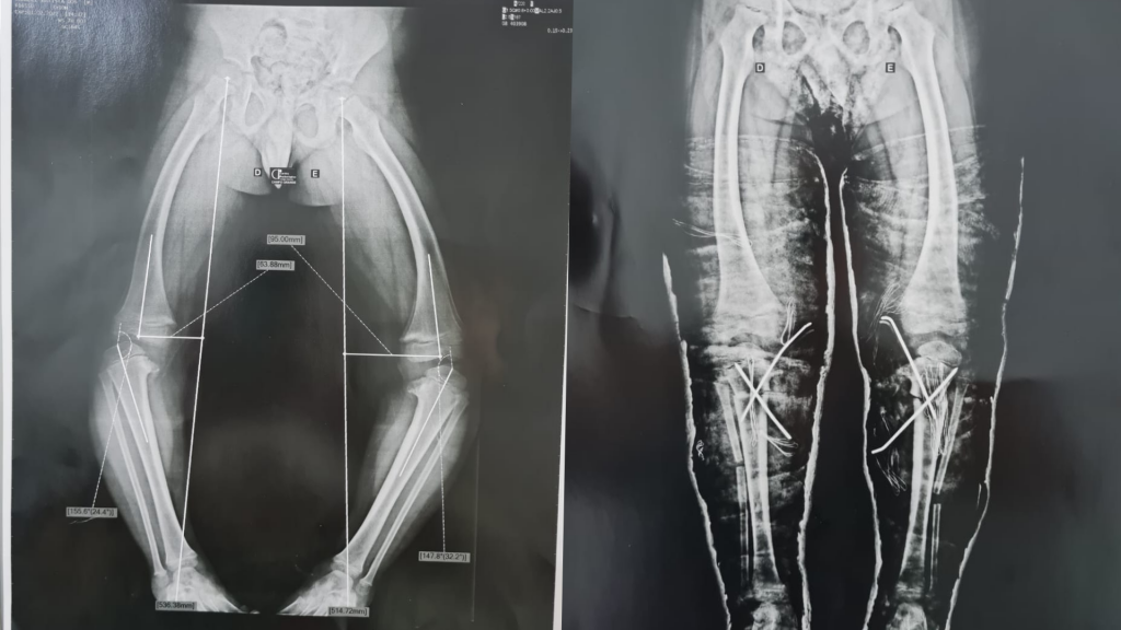 Crianças com deformidades ortopédicas tem vidas transformadas com cirurgias e tratamentos em CG