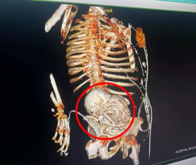 Mulher de MS descobre ter no útero feto calcificado há mais de 50 anos Mulher de MS descobre ter no útero feto calcificado há mais de 50 anos