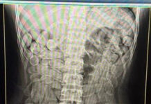 Jovens bolivianas são flagradas com mais de 200 cápsulas de cocaína no estômago