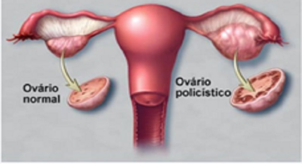 Mês da Mulher: De SOP à Menopausa, os desafios da saúde feminina são temas de conscientização