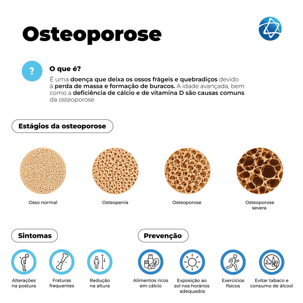 Especialista alerta que osteoporose evolui sem sintomas e reforça prevenção desde cedo Especialista alerta que osteoporose evolui sem sintomas e reforça prevenção desde cedo