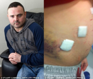 Homem tem hemorragia interna e perde mais de 1 litro de sangue após cirurgia de vesícula. Médicos disseram ser apenas “gases” Homem tem hemorragia interna e perde mais de 1 litro de sangue após cirurgia de vesícula. Médicos disseram ser apenas “gases”