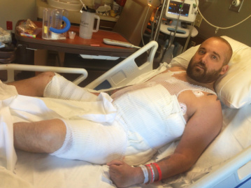 Jacob Rothe desenvolveu fasceíte necrotizante (NF) após uma cirurgia em seu estômago.