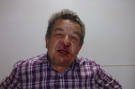 Prefeito de Toledo (MG) tem nariz quebrado por suposto adversário político Prefeito levou dois socos no rosto
Facebook/Reprodução
