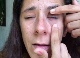 Mulher tem as pálpebras coladas após amiga confundir cola com colírio Mulher tem as pálpebras coladas após amiga confundir cola com colírio