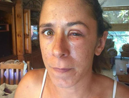 Mulher tem as pálpebras coladas após amiga confundir cola com colírio Mulher tem as pálpebras coladas após amiga confundir cola com colírio