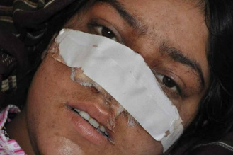 Marido corta fora nariz da esposa após mulher impedi-lo de se casar com criança de 7 anos Marido corta fora nariz da esposa após mulher impedi-lo de se casar com criança de 7 anos