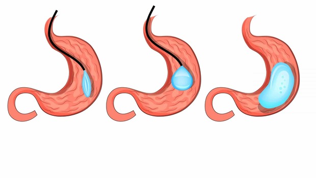 Obesidade: 10 dúvidas sobre balão intragástrico (Shutterstock)