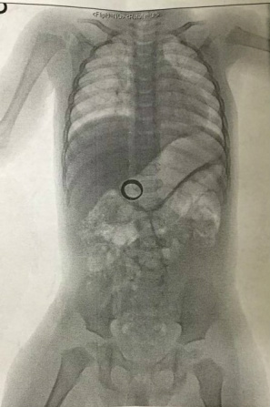 Mãe encontra anel de casamento perdido ao fazer exame de raios-X em bebê O menino de um ano engoliu o anel Foto: Reddit/ iamclarkgriswold
