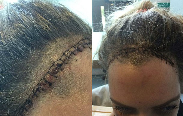 Mulher que sentia “apenas” dor de cabeça e cansaço descobre ter um tumor no cérebro Mulher que sentia “apenas” dor de cabeça e cansaço descobre ter um tumor no cérebro