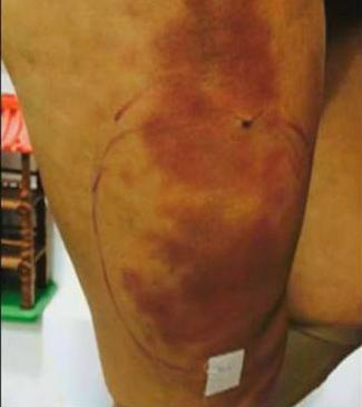 Andressa Urach Ex-miss Bumbum está sedada e inconsciente Foto: Reprodução/Rede Record