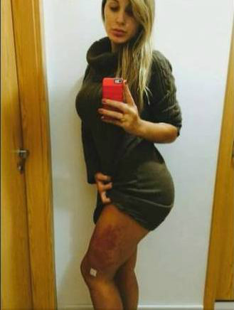 Andressa Urach Ex-miss Bumbum está sedada e inconsciente Foto: Reprodução/Rede Record