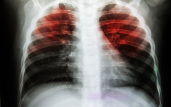 Estudo revela compostos que podem combater um tipo de tuberculose shutterstock