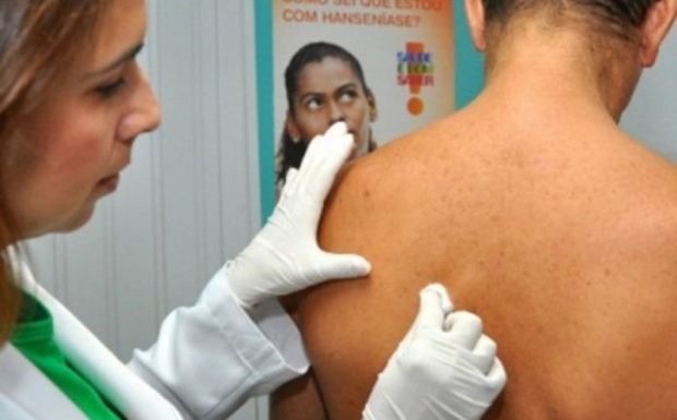 Para alertar sobre hanseníase, Janeiro Roxo terá dia D nesta sexta