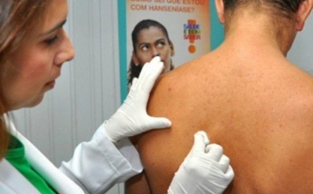 Janeiro roxo: Unidades de saúde promovem ações de prevenção à hanseníase