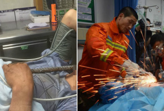 Operário milagrosamente sobrevive após barra de ferro perfurar seu queixo e sair pelo nariz Trabalhador sobreviveu sem sequelas após cair em obra e ter barra de ferro encravada no rosto, perfurando seu queixo e saindo pelo nariz. Acidente aconteceu na China.