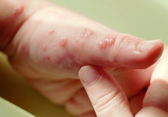 Pacientes com epidermólise bolhosa terão novo protocolo de cuidados Foto Ilustrativa