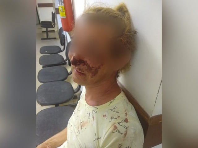 Mulher trans é espancada e tem nariz arrancado com mordida A mulher transexual foi agredida após contar para a esposa do suspeito que mantinha um relacionamento extraconjugal com ele. Arquivo pessoal