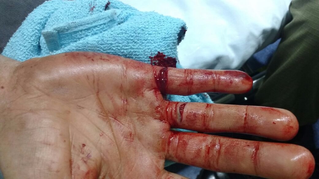 Mão da vítima de tentativa de roubo