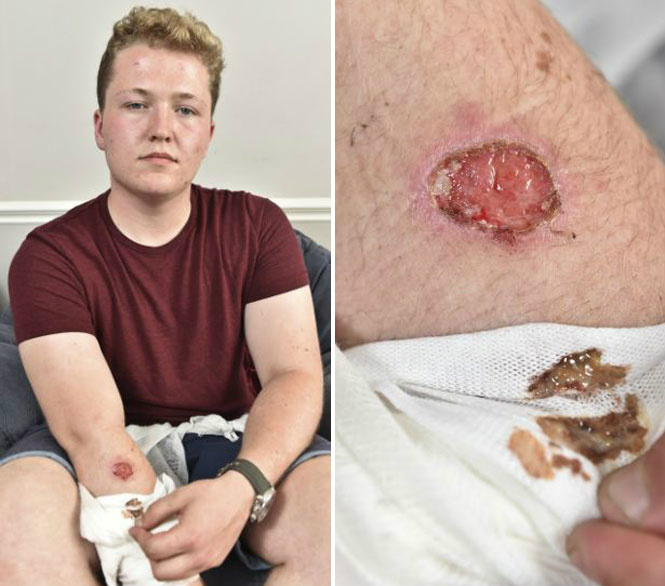 Adolescente adormece em cima de iPhone 5 e acorda com queimadura profunda no braço Jake Parker com ferimento em seu braço.
Fonte Daily Mail - Divulgação