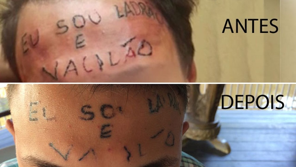 Tatuado com 'ladrão e vacilão' na testa é preso por furtar desodorantes em SP Remoção de tatuagem feita por dupla presa por tortura de jovem em São Bernardo (Foto: Glauco Araújo/G1)