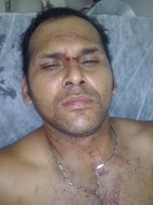 Motociclista não enxerga linha com cerol e sofre vários ferimentos no rosto O enfermeiro teve vários cortes pelo rosto devido ao cerol. (Foto:Divulgação)