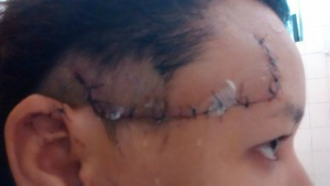 Segundo a estudante, a jovem levou 23 pontos após o acidente (Foto: Whats App da redação)