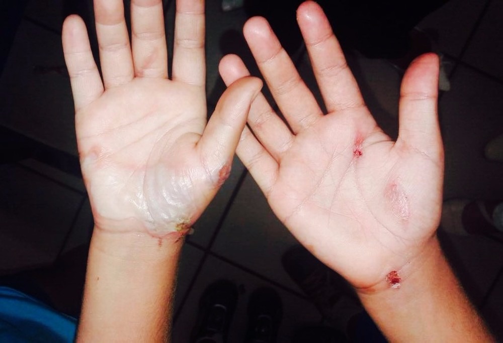 Ferimentos nas mãos da crianças após queimadura (Foto: Polícia Civil/Divulgação)