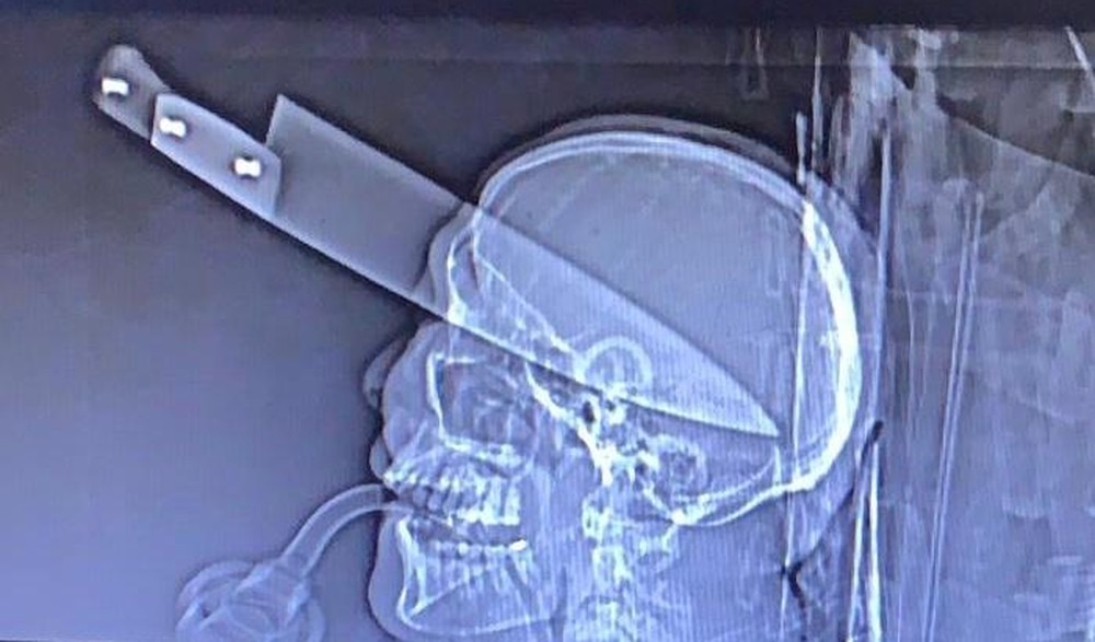 Homem que teve faca cravada no olho continua vivo Foto: Reprodução