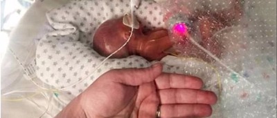 Bebê nasce com 22 semanas, 460g e do tamanho da palma da mão © Reprodução