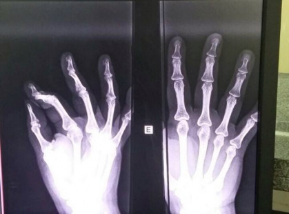 Enfurecida, gestante quebra dedo de técnica de enfermagem em UPA na Capital