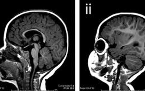 Estudo reforça relação do vírus zika com casos de microcefalia Estudo reforça relação do vírus zika com casos de microcefalia