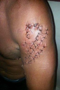 Mergulhador mostra ferimentos após ser atacado por tubarão; imagens fortes Um mergulhador tem sorte em estar vivo após ter sido atacado por um tubarão, em Sugarloaf Key, na Flórida (EUA), no último dia 13. Mark Rackley, de 48 anos, usou seu perfil no Facebook para mostrar os ferimentos que sofreu depois que o animal de 2.5 metros de comprimento abocanhou-o no braço direito, na altura dos ombros. A vítima precisou levar 58 pontos no local dos ferimentos. As informações são do jornal The Mirror.