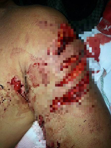 Mergulhador mostra ferimentos após ser atacado por tubarão; imagens fortes O homem sofreu ferimentos graves no braço Foto: Reprodução / Facebook