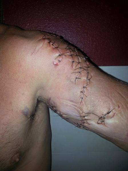 Mergulhador mostra ferimentos após ser atacado por tubarão; imagens fortes Ele levou mais de 50 pontos Foto: Reprodução / Facebook