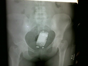 Na imagem é detectado através de um RX o aparelho de celular - Foto da Internet 