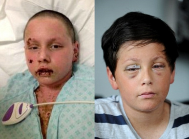 Adolescente está ficando cego após sofrer gravíssima reação alérgica ao medicamento Ibuprofeno