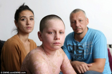 Adolescente está ficando cego após sofrer gravíssima reação alérgica ao medicamento Ibuprofeno