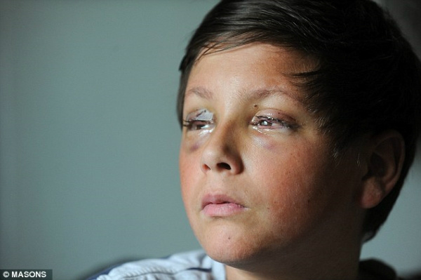 Adolescente está ficando cego após sofrer gravíssima reação alérgica ao medicamento Ibuprofeno