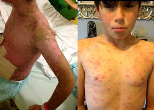 Adolescente está ficando cego após sofrer gravíssima reação alérgica ao medicamento Ibuprofeno