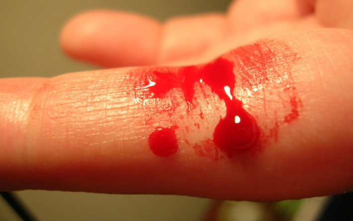 O que acontece quando você recebe sangue do tipo errado? O que acontece quando você recebe sangue do tipo errado?