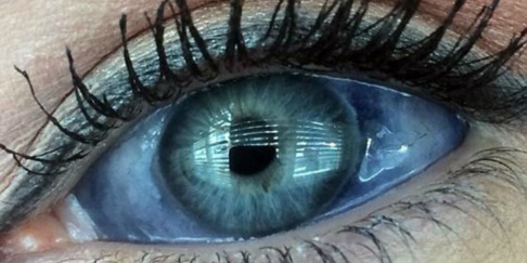 Mulher injeta tinta no globo ocular e corre o risco futuro de ficar cega Mulher injeta tinta no globo ocular e corre o risco futuro de ficar cega
