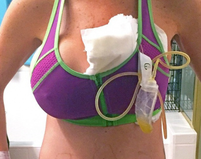 Mulher precisa amputar seio após colocar um piercing no mamilo Mulher precisa amputar seio após colocar um piercing no mamilo