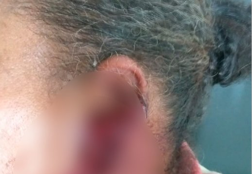 Mulher que teve orelha quase decepada pelo marido recebe alta de hospital (Foto: Rio Brilhante em Tempo Real)