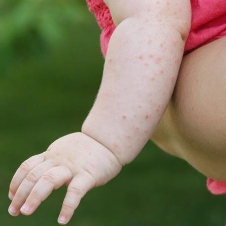 Vacina de sarampo é dada com 1 ano; como proteger antes Vacina de sarampo é dada com 1 ano; como proteger antes