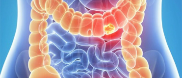 Campanha alerta população sobre o câncer de intestino