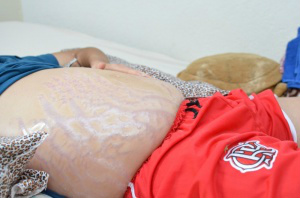 Abdomem inchado é um dos principais sintomas da Síndrome Nefrótica (Foto - Vanessa Tamires)